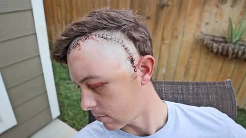 Revealing My Face After Brain Surgery (Graphic)