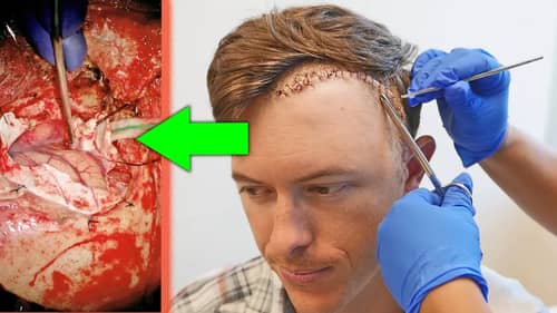 LOOKING INSIDE MY BRAIN! | What a Large Brain Tumor Looks Like