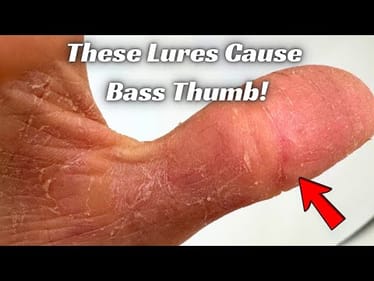 WARNING! These Fishing Lures cause Severe Bass Thumb!