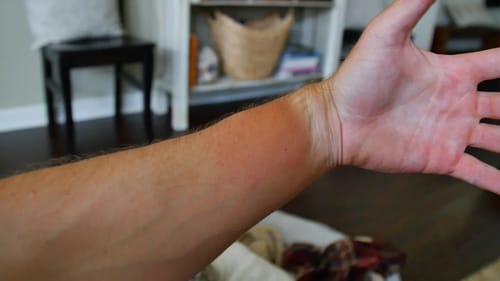 Spider Bit Me
